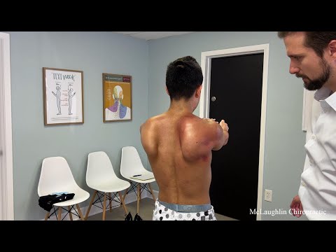 Видео: САМАЯ СИЛЬНАЯ КРЫЛОПАТА, КОТОРУЮ Я КОГДА-ЛИБО ВИДЕЛ 😳 Огромные узлы лопатки и повреждение нерва у...