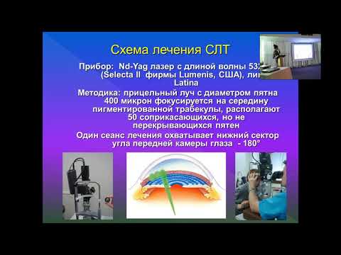 Видео: «Cелективная лазерная трабекулопластика и факоэмульсификация катаракты в лечении первичной открытоуг
