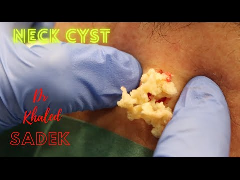 Видео: Бесконечная киста. Доктор Халед Садек. LipomaCyst.com