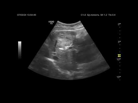 Видео: Ультразвуковая диагностика. Доктор Иогансен. Видеопримеры. Выпуск 77. Опухоли печени (3).