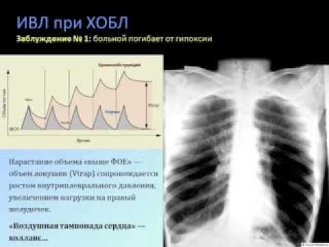 Видео: Респираторная поддержка при ХОБЛ (кИВЛ14дек) Кузьков В. В.