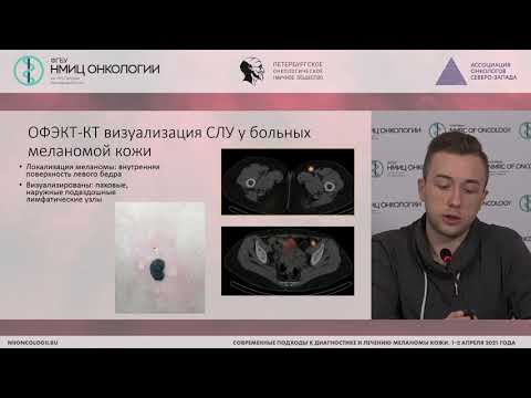Видео: Радионуклидная диагностика меланомы (Попович А.С.)