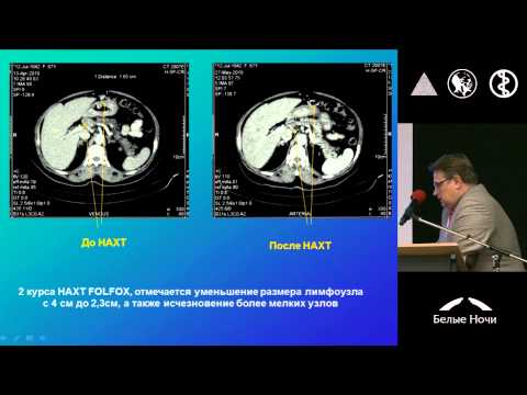 Видео: Неоадъювантная химиотерапия при лечении резектабельного рака желудка