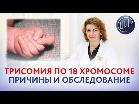 Видео: Трисомия по 18 хромосоме: причины,обследование и что делать, чтоб трисомия больше не повторилась.