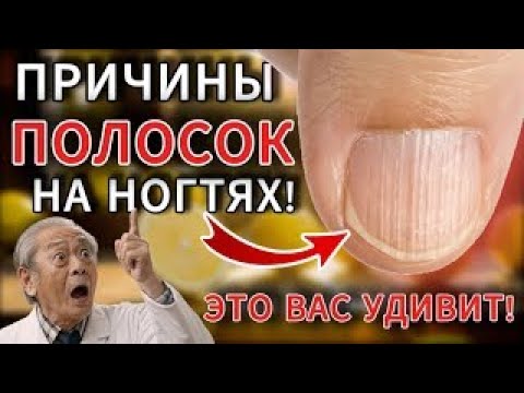Видео: Вертикальные бороздки на ногтях — Причины, симптомы и когда нужно бить тревогу!