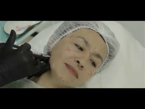 Видео: Видео-демонстрация техники инъецирования центрально-азиатского типа лица от Елены Байбариной