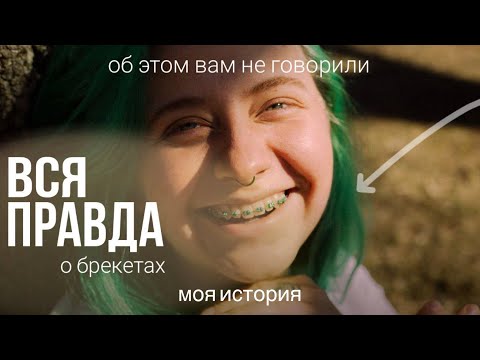 Видео: БУДЬ К ЭТОМУ ГОТОВ| БОЛЬ и СТРАХИ | МОЯ ИСТОРИЯ установки брекетов. Часть 1