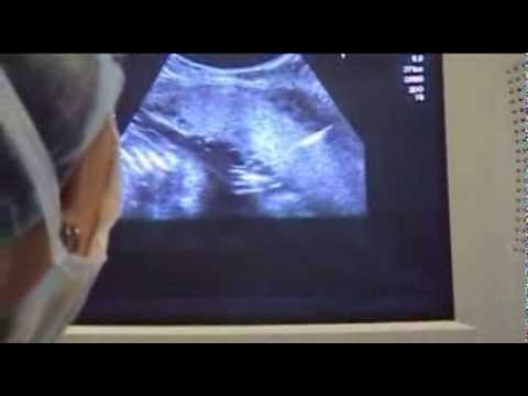 Видео: Резус-конфликт. Внутриутробное переливание крови