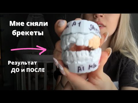 Видео: МНЕ СНЯЛИ БРЕКЕТЫ // РЕЗУЛЬТАТ ДО и ПОСЛЕ // КАК ЭТО БЫЛО?! 👈