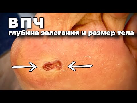 Видео: Поймать бородавку в 80 лет. Проникла глубоко и разрослась под мозолью