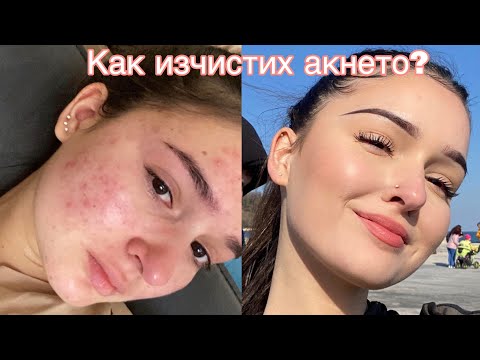 Видео: Лечение с Роакутан