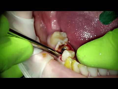 Видео: Удаление зуба, нижнего моляра с распиливанием и извлечением по корням