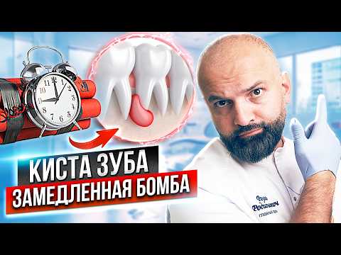 Видео: Киста зуба - как лечить? Как понять что у вас киста зуба? Киста зуба - лечить или удалять зуб?