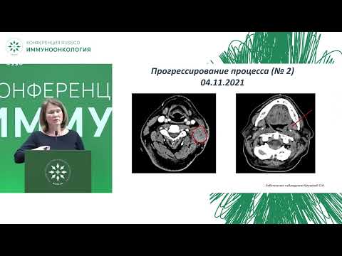 Видео: Иммуноонкология. Опухоли головы, шеи. Клинический случай