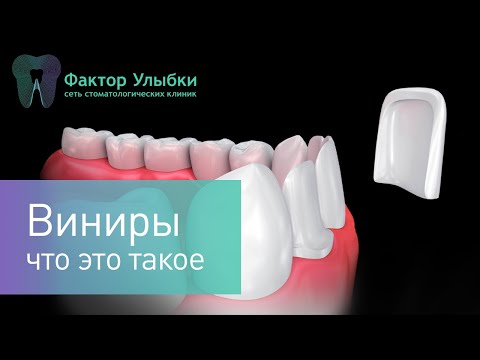 Видео: Виниры - что это такое и как их устанавливают!