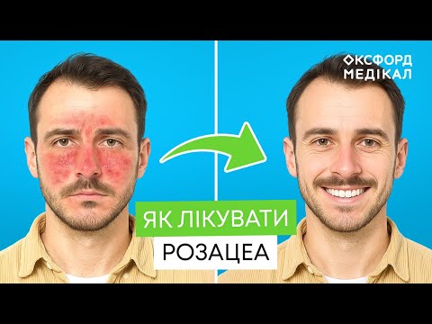 Видео: Червоне обличчя — це не просто подразнення! Вся правда про розацеа