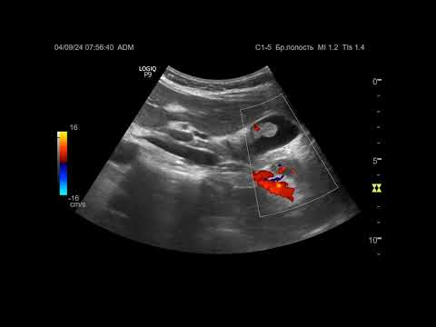 Видео: УЗИ. Доктор Иогансен. Видеопримеры. Выпуск 103. Полип желчного пузыря (3).