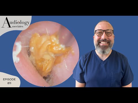 Видео: Ушная сера, которую даже консультант не смог удалить - EP811
