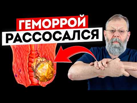 Видео: ГЕМОРРОЙ ЗАМУЧАЛ? 5 МИНУТ И ПОМОГЛИ СЕБЕ САМИ!