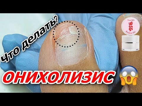 Видео: Онихолизис и как с ним работать 👣