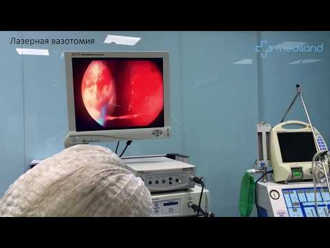 Видео: Как проходит лазерная вазотомия в МЦ «Mediland»?