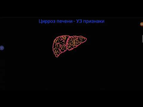 Видео: УЗ признаки цирроза печени и дифф.диагностика портальной гипертензии