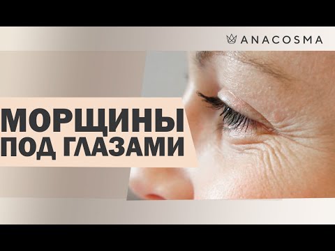 Видео: Морщины под глазами⚠️ гусиные лапки ⚠️ | Убрать дома, у косметолога⚠️