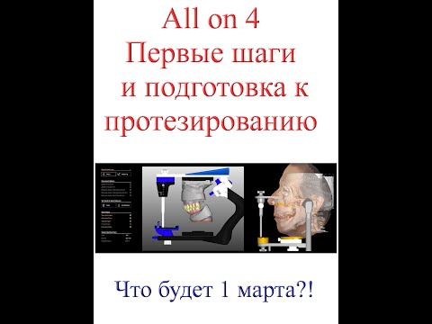 Видео: All on 4  -  ВСЁ на ЧЕТЫРЁХ! Или первые шаги к правильному протезированию