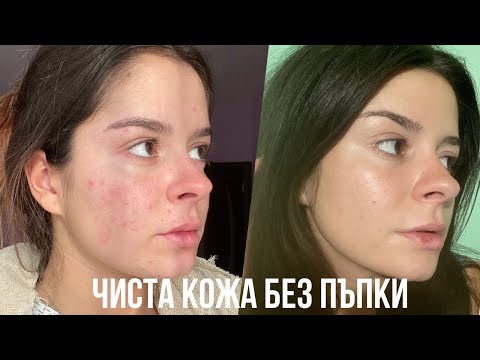 Видео: Как да се отървем от пъпки и акне завинаги