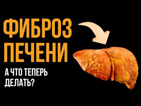Видео: ФИБРОЗ печени: что не дает печени нормально работать и насколько это опасно?
