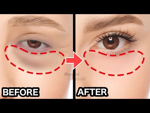 Видео: Упражнения и массаж для удаления мешков под глазами за 8 минут | Морщины вокруг глаз