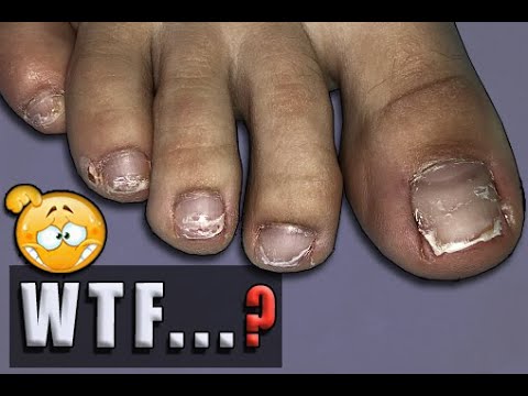 Видео: ►УЖАСНЫЙ Педикюр. ВРОСШИЙ НОГОТЬ.ПРЕОБРАЖЕНИЕ 😱 НЕ ДЛЯ СЛАБОНЕРВНЫХ.🌸 Педикюр От и До. Педикюр дома
