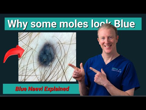 Видео: Почему некоторые родинки синие? | Объяснение синих неви