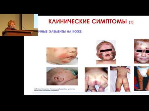 Видео: 17.02.2017 - Первые проявления пищевой аллергии у детей раннего возраста. На приеме у педиатра.