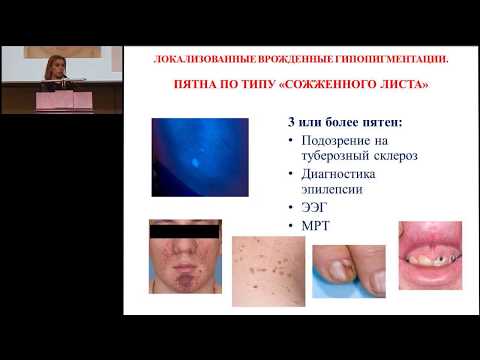 Видео: 18.02.2017 - Нарушения пигментации кожи у детей