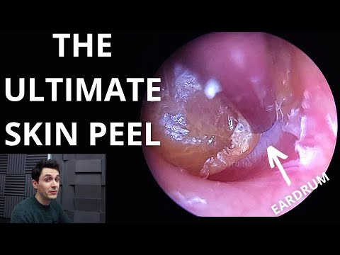 Видео: Абсолютный пилинг кожи (удаление омертвевшей кожи с защемленной барабанной перепонки)
