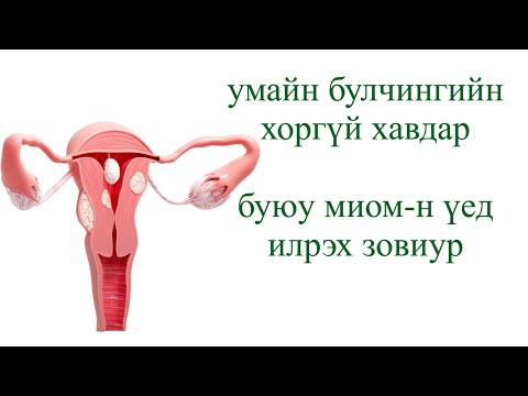 Видео: умайн булчингийн хоргүй хавдар буюу миом болон киста 2-н ялгаа