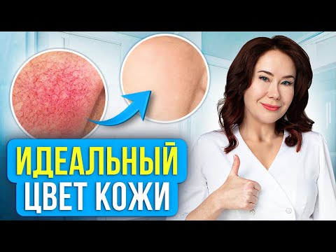 Видео: Реальное лечение КУПЕРОЗА. Избавься от СОСУДОВ на коже.