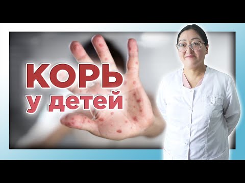 Видео: КОРЬ | Вакцинация. Симптомы. Диагностика. Лечение
