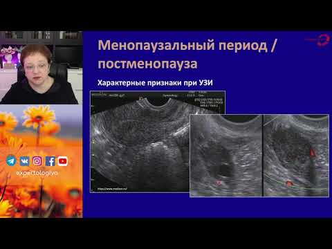 Видео: Экспертология | Кровотечение при МГТ