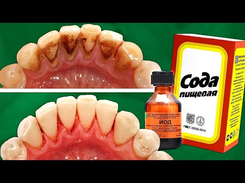 Видео: ТИШЛАРНИ ТОШДАН ТОЗАЛАШ САРҒАЙГАН ТИШЛАР ОППОҚ БЎЛАДИ УЙ ШАРОИТИДА