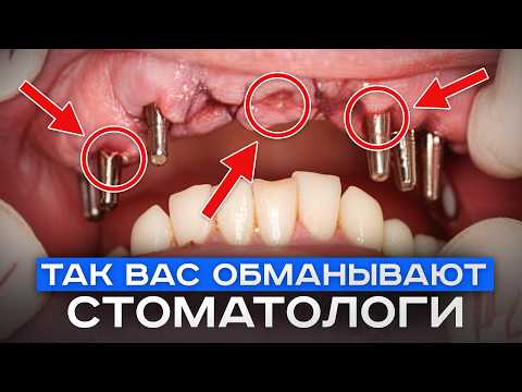 Видео: СРОЧНО смотрите, если не хотите потерять все зубы! Что такое базальная имплантация?