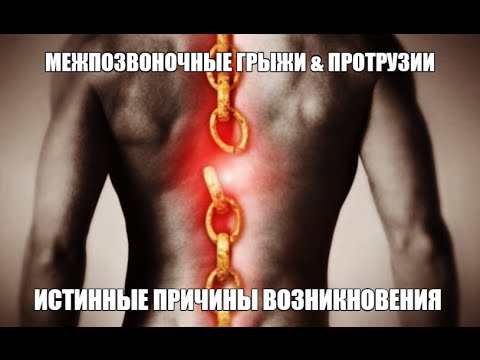 Видео: Межпозвоночные грыжи и Протрузии ИСТИННЫЕ ПРИЧИНЫ ВОЗНИКНОВЕНИЯ
