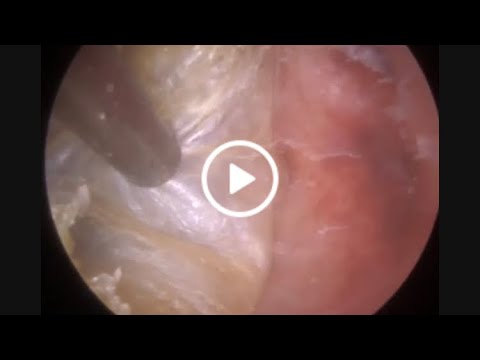 Видео: 939 - Обтурирующий кератоз: случай из практики