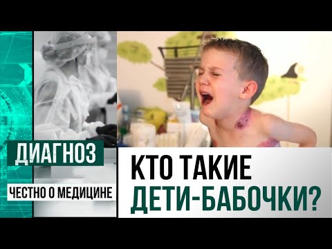 Видео: Болезнь бабочки или буллезный эпидермолиз: как в РК помогают тем, кого нельзя обнять? | Диагноз