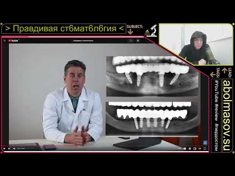 Видео: Правдивая стоматология проф Аболмасов Н.Н. - Часть 89 "Имплантация при полной потере зубов. Методы!"