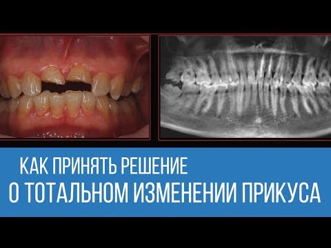 Видео: Протокол принятия решения о тотальном протезировании и изменении прикуса / доктор Будовский