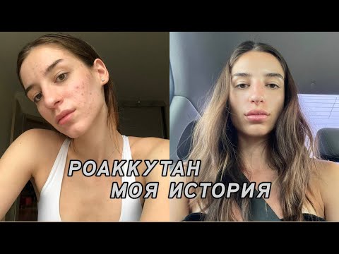 Видео: РОАККУТАН МОЯ ИСТОРИЯ! Рецидив, Акнетрент, почему я решилась пить ретиноиды второй раз