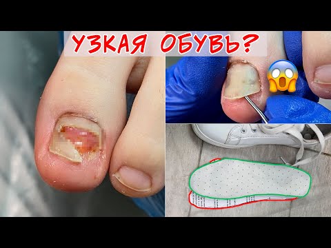 Видео: Онихолизис на ногах / Последствия узкой обуви