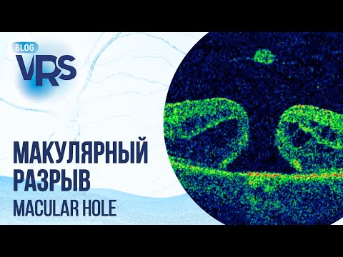 Видео: Макулярный разрыв. Хирургическое лечение | Macular hole. Treatment